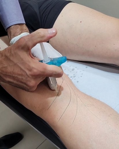 Aplicación de técnica PIT en rodilla, marcando puntos de inyección